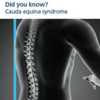 Read more: Cauda equina syndrome