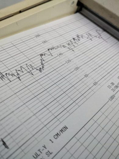 Printout from a medical monitoring device showing waveform data and measurements